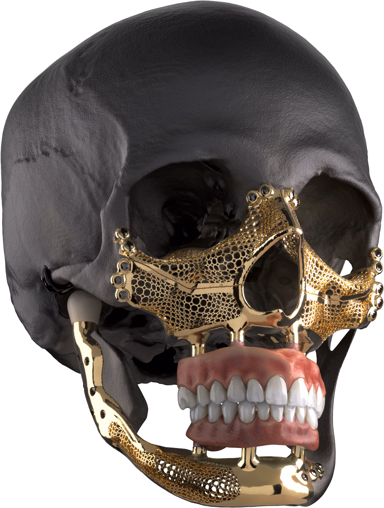 Patient specific maxillofacial reconstruction on an anatomical model, front view
